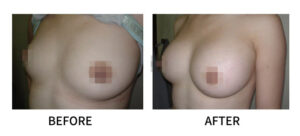 Breast Fat Grafting vs. Breast Implants