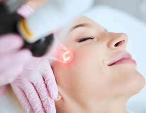 Fraxel laser for acne scars