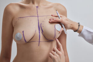 breast fat grafting