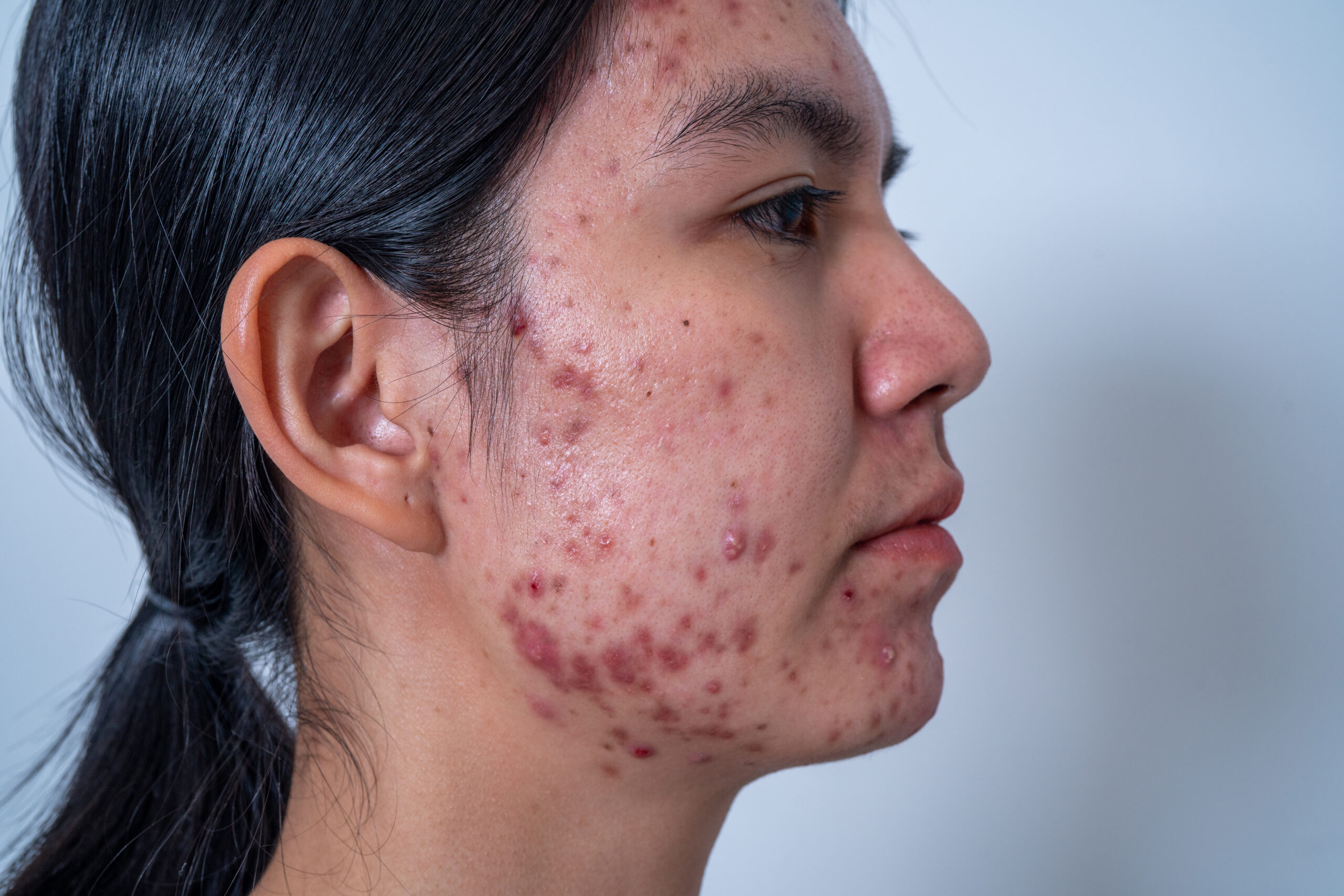 Photodynamic Therapy: Acne Solution Explored