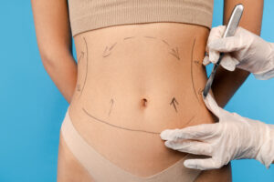 abdominal liposuction