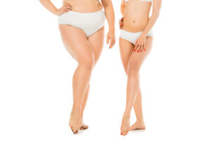 Thigh liposuction