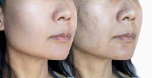 Fraxel laser for acne scars