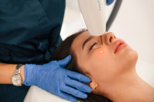 Fraxel laser for acne scars