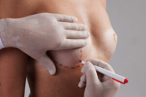 fat grafting breast enhancement 