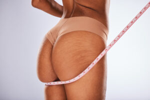 Buttocks fat grafting