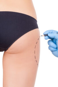 Thigh Liposuction in Korea