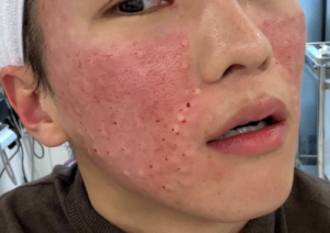 Rejuran Healer Side Effects