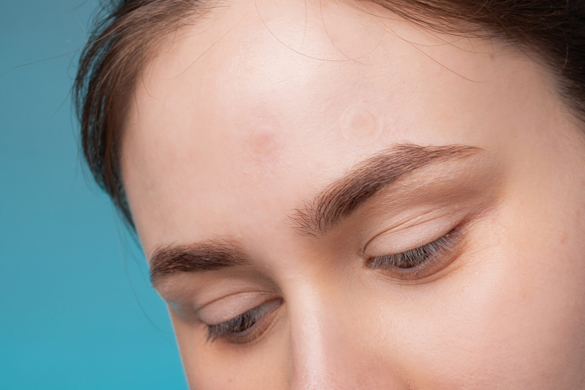 Forehead & Temple Fat Grafting: Restoring Youthful Volume